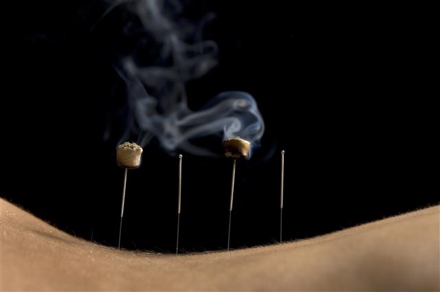 acupuncture for relaxation