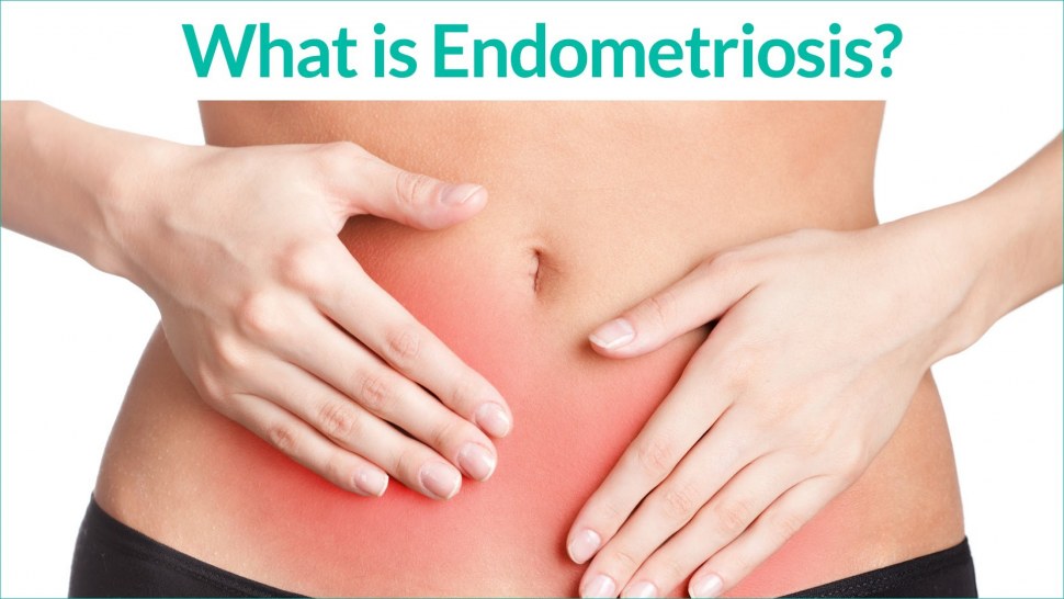 What Is Endometriosis