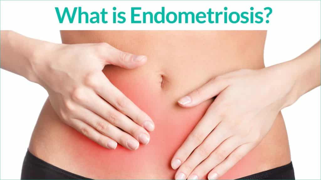 Endometriosis Can Acupuncture Help?